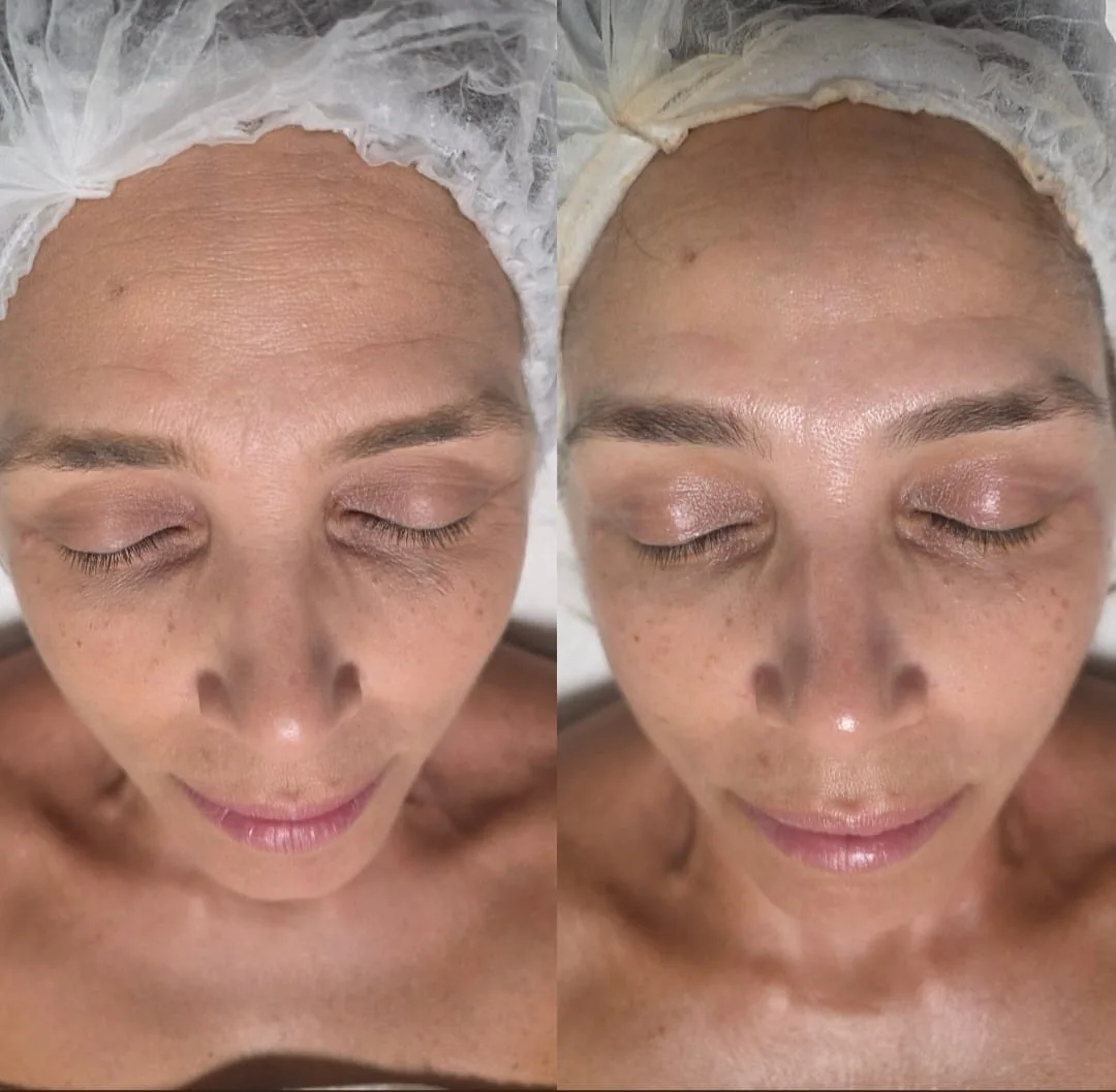 Antes e depois do procedimento estético não invasivo conhecido como botox sem agulha — Hortolândia/SP