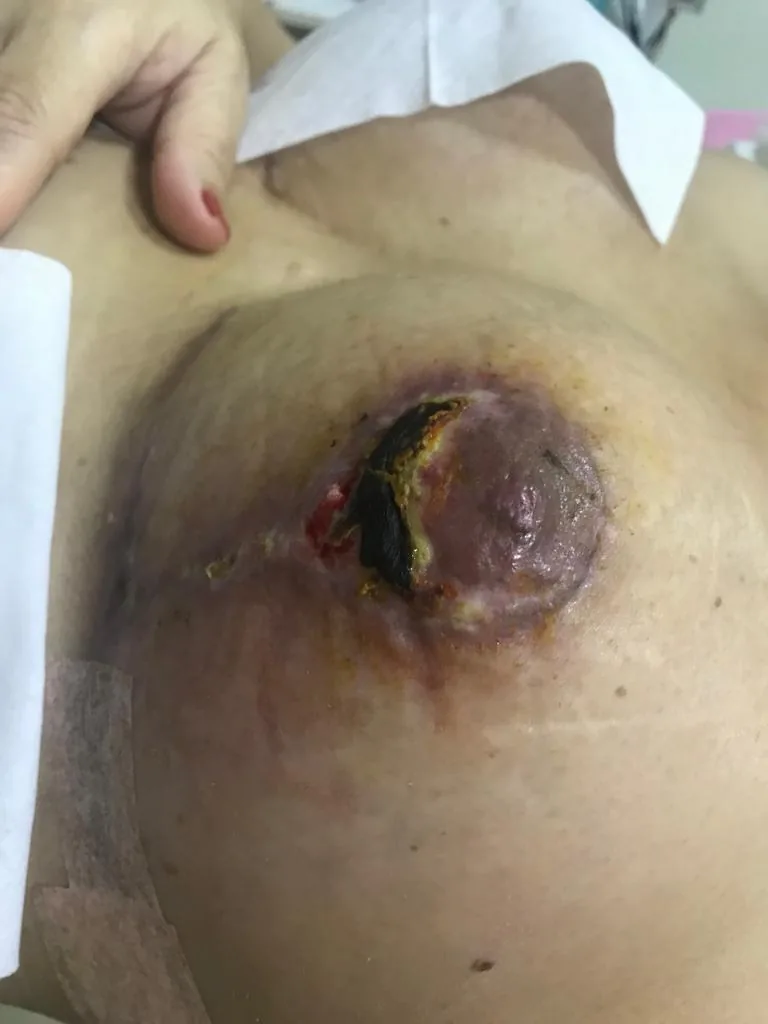 Cicatriz de mama depois do laser para cicatriz de mama em Hortolândia/SP — segundo registro