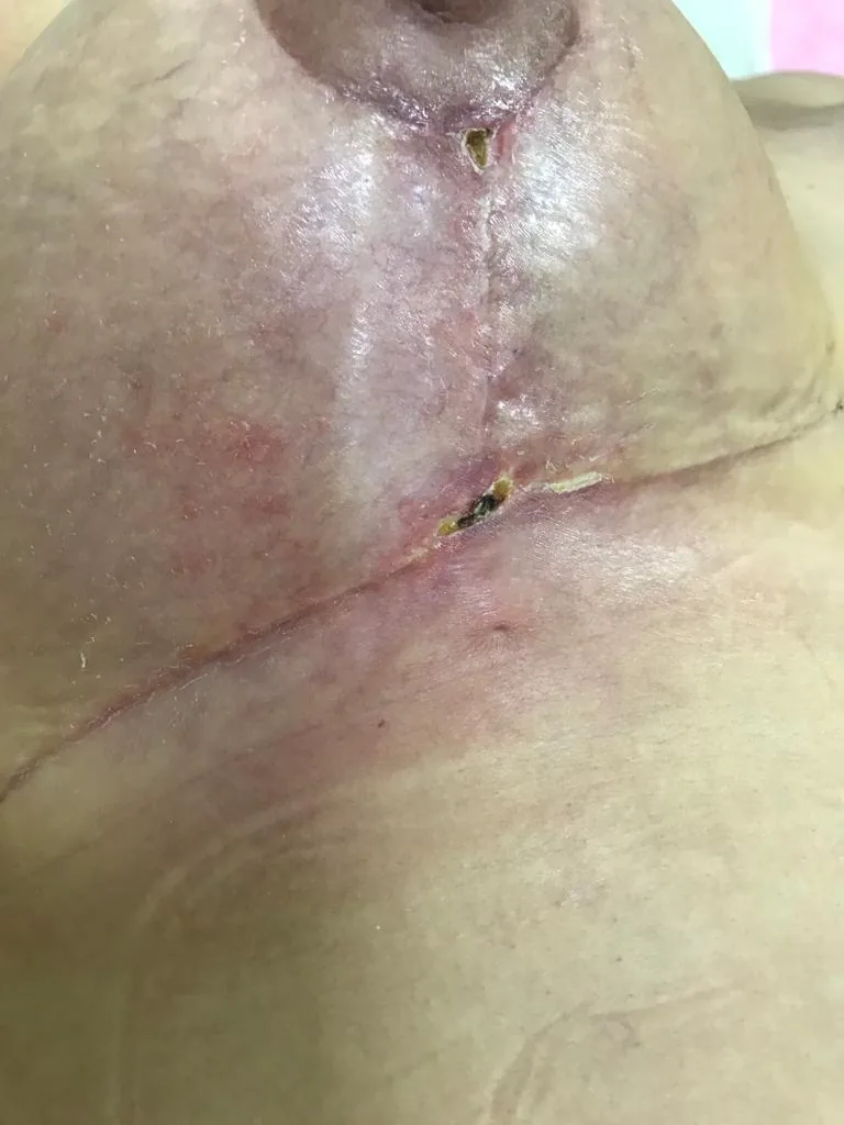 Cicatriz de mama — depois do protocolo de laser em Hortolândia